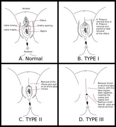 Type d excision